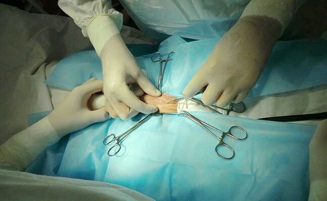 La chirurgie de l'organe reproducteur contribuera à augmenter sa taille
